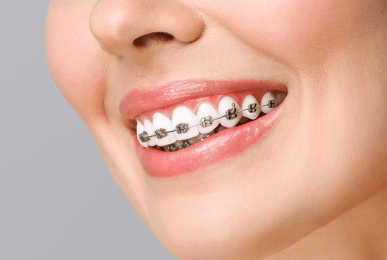 orthodontic braces in qatar