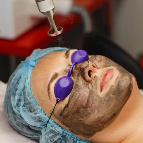 carbon laser peel in qatar