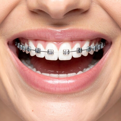 metal braces treatment