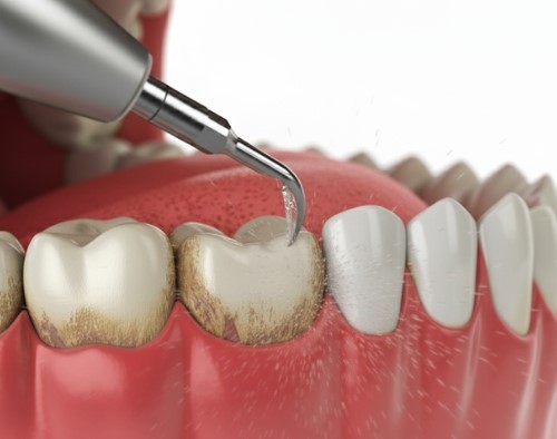 scaling and polishing