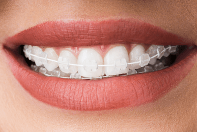 ceramic braces