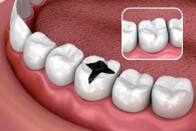 Dental fillings