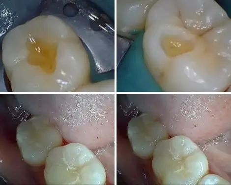 filling before and after