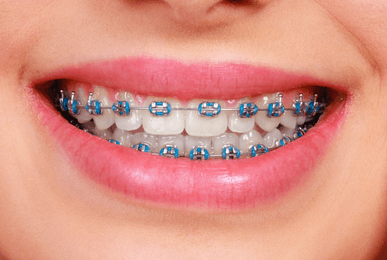 metal braces