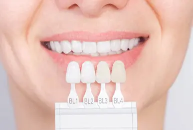 Veneers
