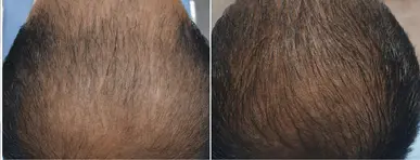 before and after