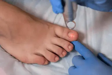 nail fungus treatment
