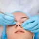 Comedone Removal
